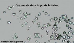 Calcium Oxalate Crystals in Urine: Causes, Diagnosis, Normal Range