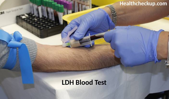 LDH Blood Test: Purpose, Preparation, Procedure, Results