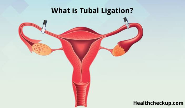 Tubal Ligation Procedure - Long Term Side Effects, Recovery