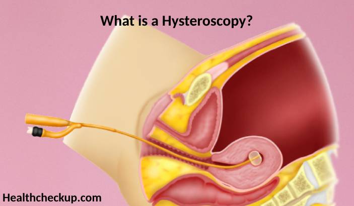 Hysteroscopy: Purpose, Preparation, Procedure, Results, and Risks