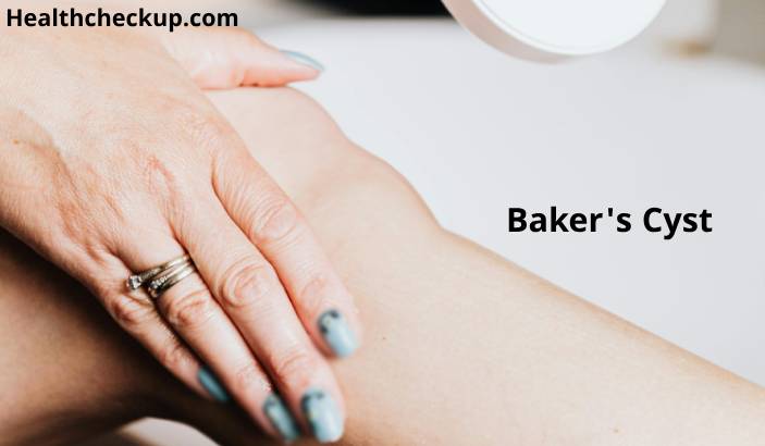 Baker's Cyst Behind the Knee: Symptoms, Treatment, and Pictures