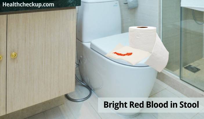 Painless Bright Red Blood in Stool: 6 Common Causes