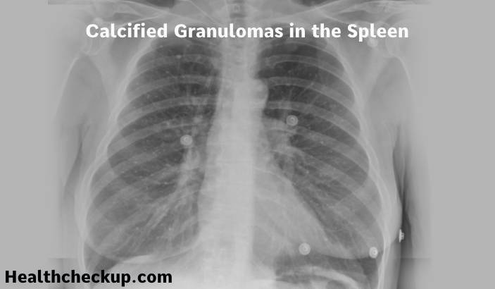 Calcified Granulomas in the Spleen: Causes, Symptoms, Diagnosis, Treatment