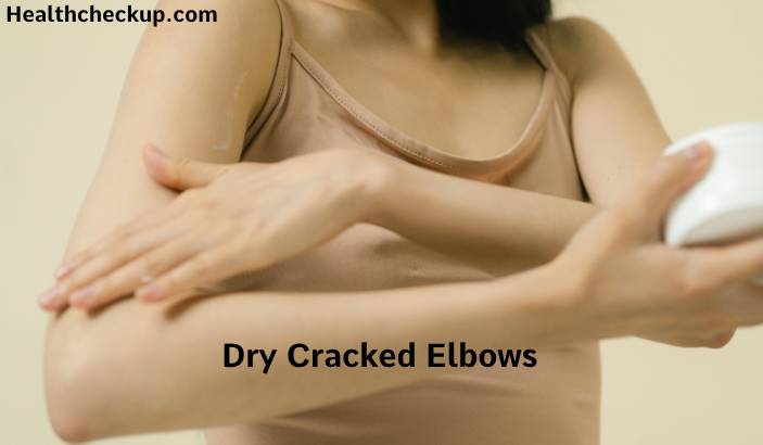 Cracked Elbow Skin: Symptoms, Causes, and Treatment