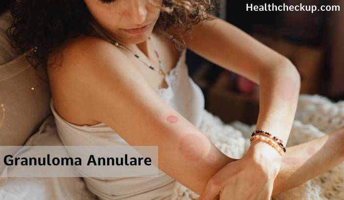 Granuloma Annulare: Pictures, Causes, Diagnosis, and Treatment Options