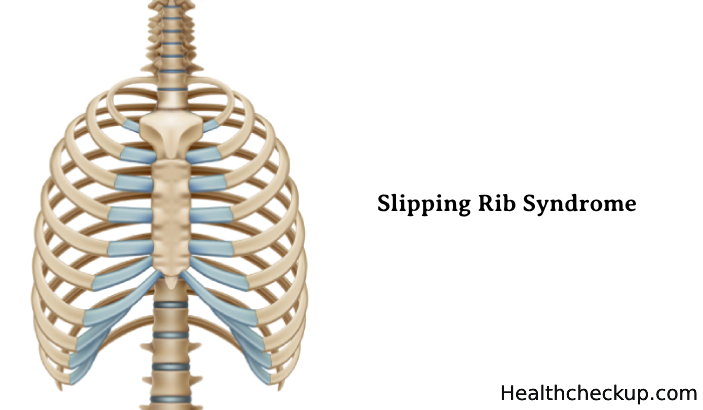 Slipping Rib Syndrome