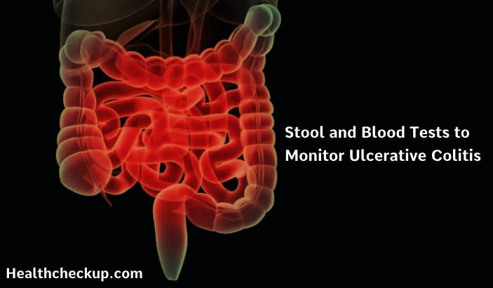 Stool and Blood Tests to Monitor Ulcerative Colitis