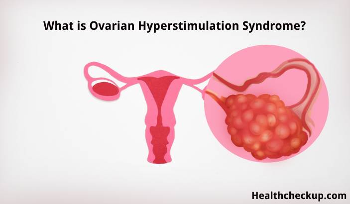 Ovarian Hyperstimulation Syndrome: Symptoms, Causes & Treatment
