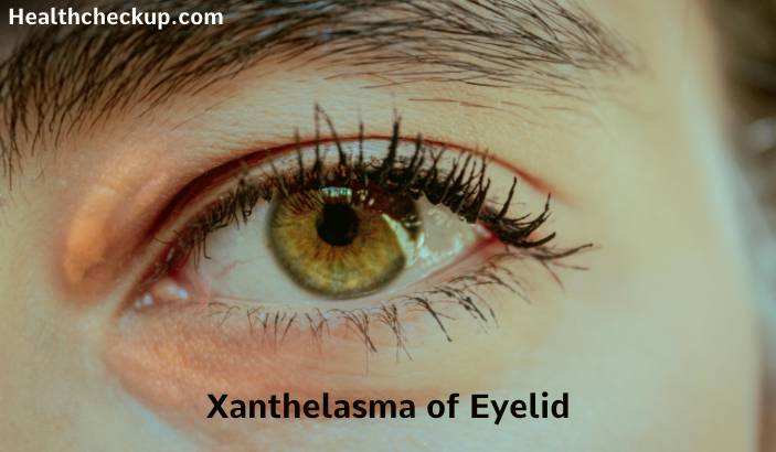 Xanthelasma - Causes and Removal Treatment Options