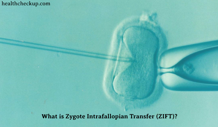 What is Zygote Intrafallopian Transfer (ZIFT)?