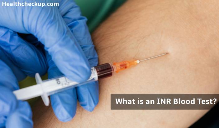 International Normalized Ratio (INR) Blood Test