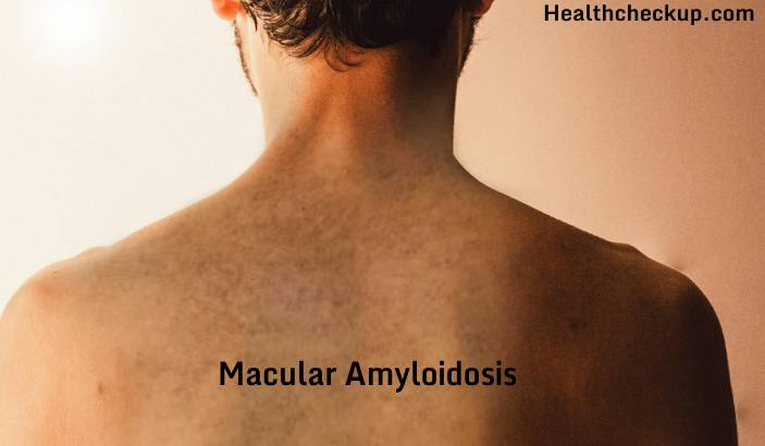 Macular Amyloidosis - Causes, Symptoms, and Treatment