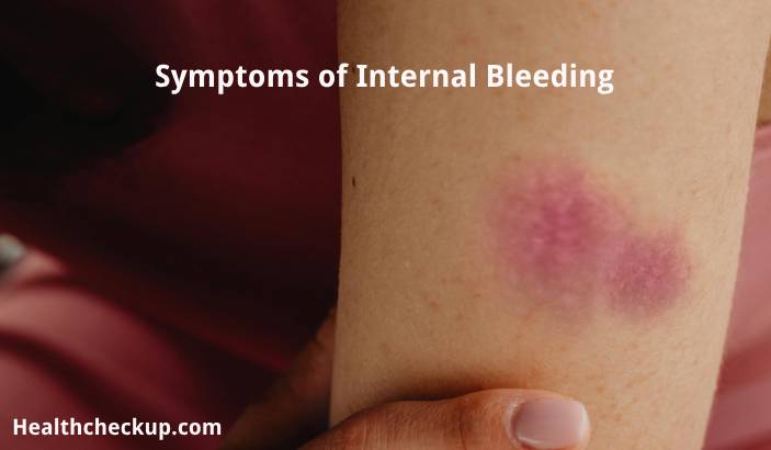 Internal Bleeding - Signs and Symptoms, Causes & More